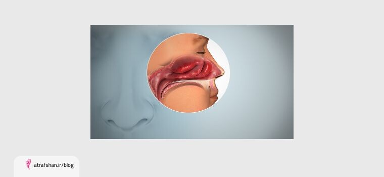 اختلال در حس بویایی معمولا موقتی است